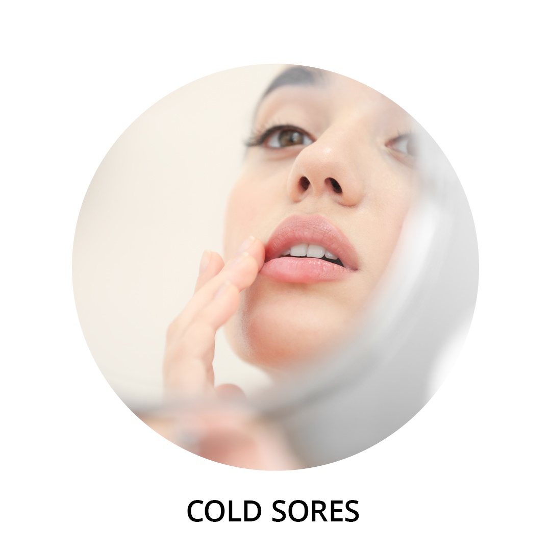  Cold Sores